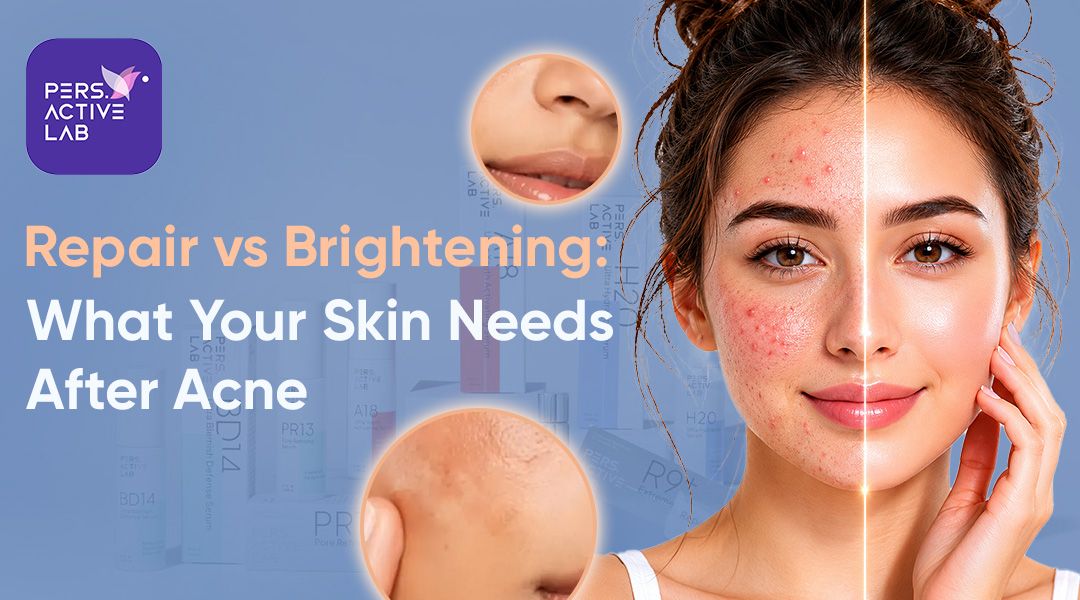 Top 10 Acne Treatments for Sensitive Skin - Pers Active Lab