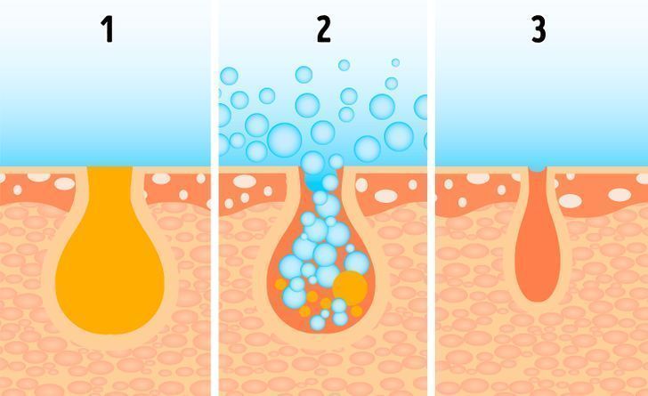 Acne, Oil & Open Pores- The Science-Backed Way to Clearer Skin